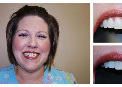 Amy Before and After from Bright Smiles Dental, Chesterfield, VA