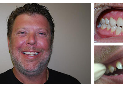 Bill Before and After from Bright Smiles Dental, Chesterfield, VA