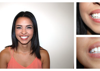 Brittney Before and After from Bright Smiles Dental, Chesterfield, VA