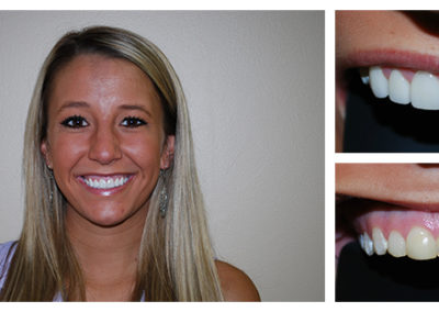 Kaitlin Before and After from Bright Smiles Dental, Chesterfield, VA