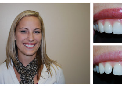 Jamie Before and After from Bright Smiles Dental, Chesterfield, VA