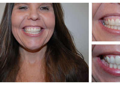 Sarah Before and After from Bright Smiles Dental, Chesterfield, VA