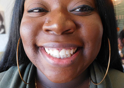 Sasha Before and After from Bright Smiles Dental, Chesterfield, VA